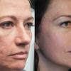 Skin Tightening - NEW Treatments!