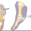 Minimally Invasive Foot Surgery